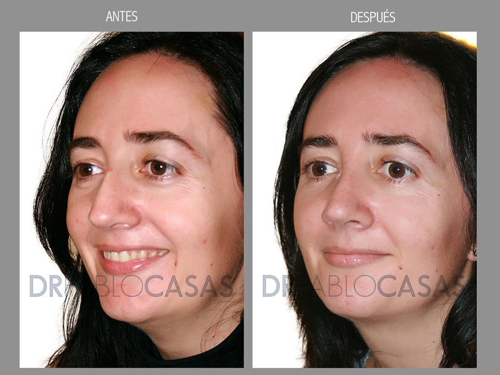 rinoplastia